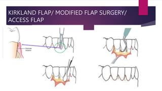 KIRKLAND FLAP/ MODIFIED FLAP SURGERY/
ACCESS FLAP
 