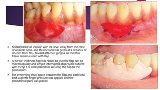  horizontal bevel incision with its bevel away from the crest
of alveolar bone, and this incision was given at a distance of
0.5 mm from MGJ toward attached gingiva so that this
tissue remains intact with flap
 A partial-thickness flap was raised so that the flap can be
moved apically and simple interrupted absorbable sutures
with Vicryl 4-0 were placed for securing the flap to the
periosteum.
 For preventing dead space between the flap and periosteal
bed, a gentle finger pressure was applied and the
periodontal pack was placed
 