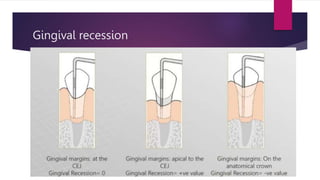 Gingival recession
 