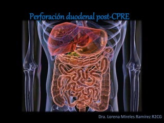 Perforación duodenal post-CPRE
Dra. Lorena Mireles Ramírez R2CG
 