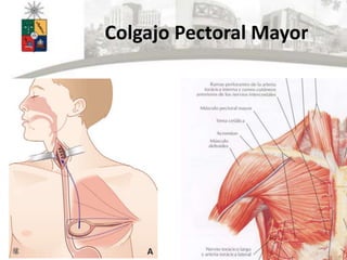 Colgajo Pectoral Mayor
 