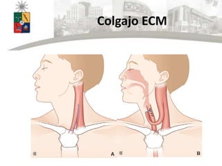 Colgajo ECM
 