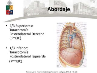 Abordaje
• 2/3 Superiores:
Toracotomía
Posterolateral Derecha
(5to EIC)
• 1/3 Inferior:
Toracotomía
Posterolateral Izquierda
(7mo EIC)
Rosiere A, et al. Tratamiento de las perforaciones esofágicas. EMC. E – 40-220.
 