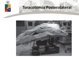 Toracotomía Posterolateral
 