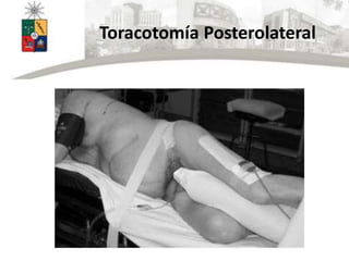 Toracotomía Posterolateral
 