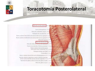 Toracotomía Posterolateral
 