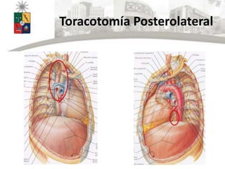 Toracotomía Posterolateral
 