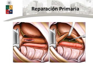 Reparación Primaria
 