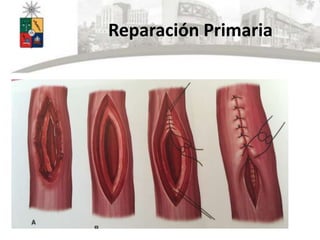 Reparación Primaria
 