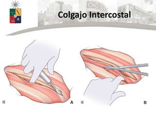 Colgajo Intercostal
 
