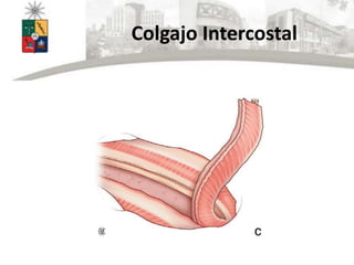 Colgajo Intercostal
 