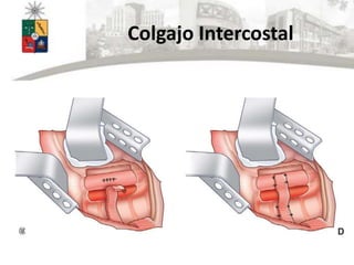 Colgajo Intercostal
 