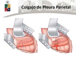 Colgajo de Pleura Parietal
 