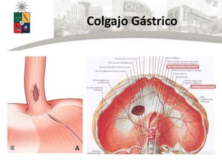 Colgajo Gástrico
 
