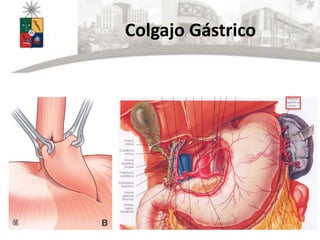 Colgajo Gástrico
 