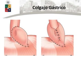 Colgajo Gástrico
 