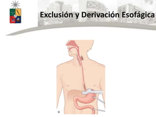 Exclusión y Derivación Esofágica
 