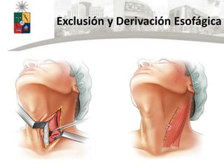 Exclusión y Derivación Esofágica
 