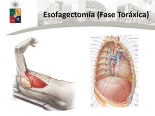 Esofagectomía (Fase Toráxica)
 