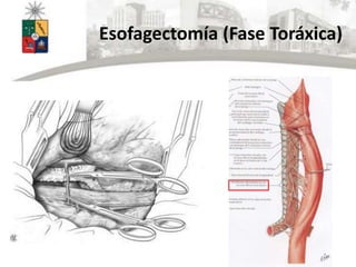 Esofagectomía (Fase Toráxica)
 