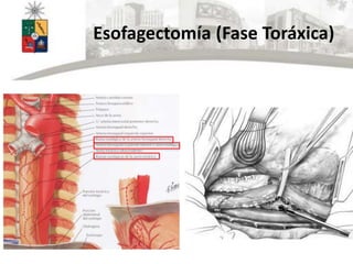 Esofagectomía (Fase Toráxica)
 