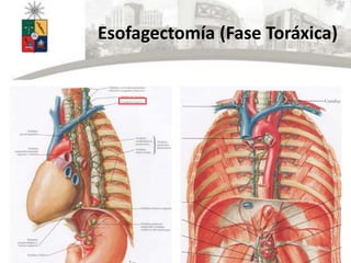 Esofagectomía (Fase Toráxica)
 