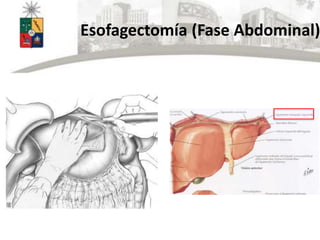 Esofagectomía (Fase Abdominal)
 