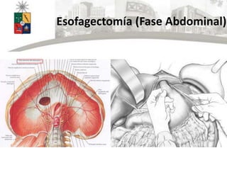 Esofagectomía (Fase Abdominal)
 