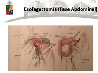 Esofagectomía (Fase Abdominal)
 