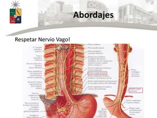 Abordajes
Respetar Nervio Vago!
 