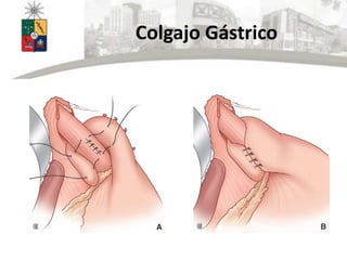 Colgajo Gástrico
 