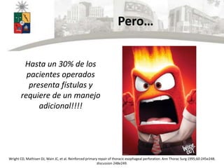 Pero…
Hasta un 30% de los
pacientes operados
presenta fístulas y
requiere de un manejo
adicional!!!!
Wright CD, Mathisen DJ, Wain JC, et al. Reinforced primary repair of thoracic esophageal perforation. Ann Thorac Surg 1995;60:245e248;
discussion 248e249.
 