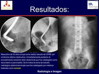 Resultados:




Masculino de 53 años al que se le realizo estudio de CPRE por
síndrome ictérico obstructivo. Inmediatamente posterior al
procedimiento presento dolor abdominal que fue catalogado como
secundario a pancreatitis. Se le indico la toma de estudio
radiológico abdominal simple que fue catalogado por médicos
tratantes como normal.
                                        Radiología e Imagen
 