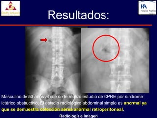 Resultados:




Masculino de 53 años al que se le realizo estudio de CPRE por síndrome
ictérico obstructivo. El estudio radiológico abdominal simple es anormal ya
que se demuestra colección aérea anormal retroperitoneal.
                             Radiología e Imagen
 