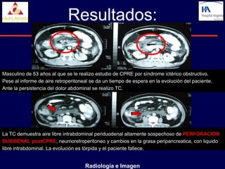 Resultados:


Masculino de 53 años al que se le realizo estudio de CPRE por síndrome ictérico obstructivo.
Pese al informe de aire retroperitoneal se da un tiempo de espera en la evolución del paciente.
Ante la persistencia del dolor abdominal se realizo TC.




La TC demuestra aire libre intrabdominal periduodenal altamente sospechoso de PERFORACION
DUODENAL postCPRE, neumoretroperitoneo y cambios en la grasa peripancreatica, con liquido
libre intrabdominal. La evolución es tórpida y el paciente fallece.


                                     Radiología e Imagen
 