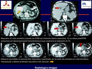Masculino, 81 años sometido a estudio de CPRE por síndrome ictérico obstructivo. En su status postCPRE
evoluciona con descompensación hemodinámica lo que condiciona la realización de TC.




Nótese la neumobilia, la vesícula biliar distendida y opacificada por el medio de contraste con nivel hidroaéreo
intravesicular y defecto de llenado secundario a lito vesicular.


                                           Radiología e Imagen
 