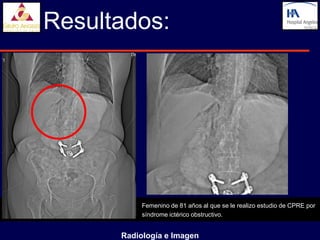 Resultados:




           Femenino de 81 años al que se le realizo estudio de CPRE por
           síndrome ictérico obstructivo.


      Radiología e Imagen
 