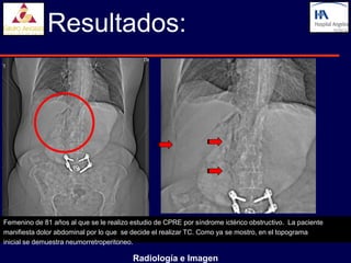 Resultados:




Femenino de 81 años al que se le realizo estudio de CPRE por síndrome ictérico obstructivo. La paciente
manifiesta dolor abdominal por lo que se decide el realizar TC. Como ya se mostro, en el topograma
inicial se demuestra neumorretroperitoneo.

                                         Radiología e Imagen
 