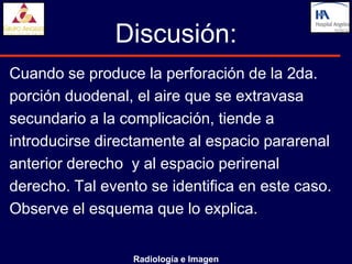 Discusión:
Cuando se produce la perforación de la 2da.
porción duodenal, el aire que se extravasa
secundario a la complicación, tiende a
introducirse directamente al espacio pararenal
anterior derecho y al espacio perirenal
derecho. Tal evento se identifica en este caso.
Observe el esquema que lo explica.


                  Radiología e Imagen
 