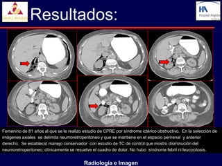 Resultados:




Femenino de 81 años al que se le realizo estudio de CPRE por síndrome ictérico obstructivo. En la selección de
imágenes axiales se delimita neumoretroperitoneo y que se mantiene en el espacio perirenal y anterior
derecho. Se estableció manejo conservador con estudio de TC de control que mostro disminución del
neumoretroperitoneo; clínicamente se resuelve el cuadro de dolor. No hubo síndrome febril ni leucocitosis.


                                         Radiología e Imagen
 