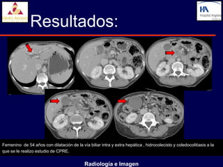 Resultados:




Femenino de 54 años con dilatación de la vía biliar intra y extra hepática , hidrocolecisto y coledocolitiasis a la
que se le realizo estudio de CPRE.


                                            Radiología e Imagen
 
