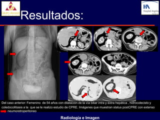 Resultados:




Del caso anterior: Femenino de 54 años con dilatación de la vía biliar intra y extra hepática , hidrocolecisto y
coledocolitiasis a la que se le realizo estudio de CPRE. Imágenes que muestran status postCPRE con extenso
    neumoretroperitoneo

                                           Radiología e Imagen
 
