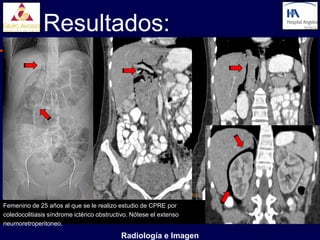 Resultados:




Femenino de 25 años al que se le realizo estudio de CPRE por
coledocolitiasis síndrome ictérico obstructivo. Nótese el extenso
neumoretroperitoneo.

                                           Radiología e Imagen
 
