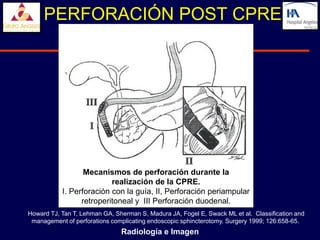PERFORACIÓN POST CPRE




                  Mecanismos de perforación durante la
                          realización de la CPRE.
           I. Perforación con la guía, II, Perforación periampular
                 retroperitoneal y III Perforación duodenal.
Howard TJ, Tan T, Lehman GA, Sherman S, Madura JA, Fogel E, Swack ML et al. Classification and
 management of perforations complicating endoscopic sphincterotomy. Surgery 1999; 126:658-65.
                               Radiología e Imagen
 
