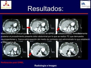 Resultados:


Masculino de 54 años al que se le realizo estudio de CPRE por coledocolitiasis. Inmediatamente
posterior al procedimiento presento dolor abdominal por lo que se realizo TC que demuestra
neumoperitoneo y franca extravasación del medio de contraste oral administrado lo que estableció
el diagnostico de




Perforación post CPRE.
                                    Radiología e Imagen
 