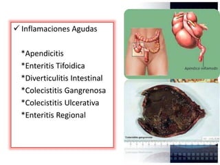  Inflamaciones Agudas
*Apendicitis
*Enteritis Tifoidica
*Diverticulitis Intestinal
*Colecistitis Gangrenosa
*Colecistitis Ulcerativa
*Enteritis Regional
 