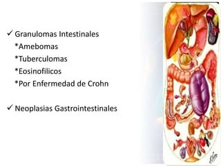  Granulomas Intestinales
*Amebomas
*Tuberculomas
*Eosinofilicos
*Por Enfermedad de Crohn
 Neoplasias Gastrointestinales
 