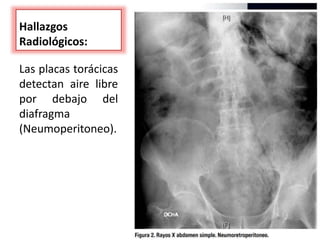 Hallazgos
Radiológicos:
Las placas torácicas
detectan aire libre
por debajo del
diafragma
(Neumoperitoneo).
 