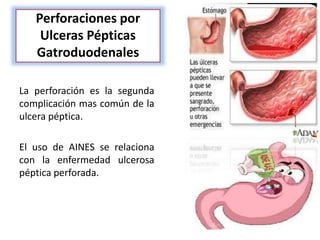 Perforaciones por
Ulceras Pépticas
Gatroduodenales
La perforación es la segunda
complicación mas común de la
ulcera péptica.
El uso de AINES se relaciona
con la enfermedad ulcerosa
péptica perforada.
 