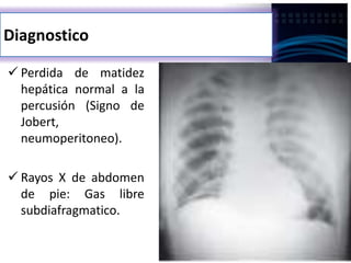 Diagnostico
 Perdida de matidez
hepática normal a la
percusión (Signo de
Jobert,
neumoperitoneo).
 Rayos X de abdomen
de pie: Gas libre
subdiafragmatico.
 